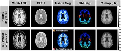 Relaxation-Compensated Chemical Exchange Saturation Transfer MRI in the Brain at 7T: Application in Relapsing-Remitting Multiple Sclerosis